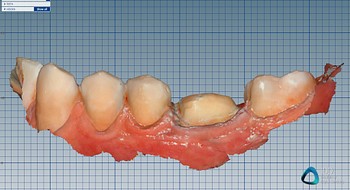 In-house crown fabricated using CS 3700 PLY scans and exocad