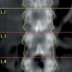 Close-up view of a DEXA scan machine arm positioned over a patient's hip during a bone density test.