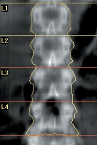 Close-up view of a DEXA scan machine arm positioned over a patient's hip during a bone density test.