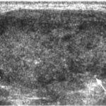 Ultrasound of solid hypoechoic follicular thyroid cancer (arrows).