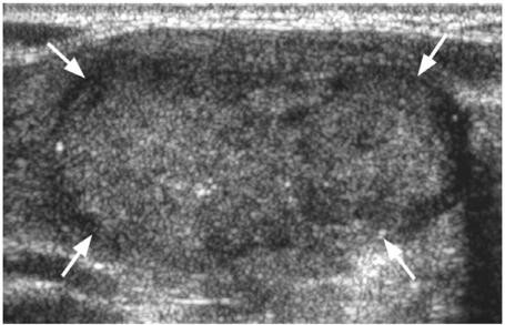 Ultrasound of solid hypoechoic follicular thyroid cancer (arrows).