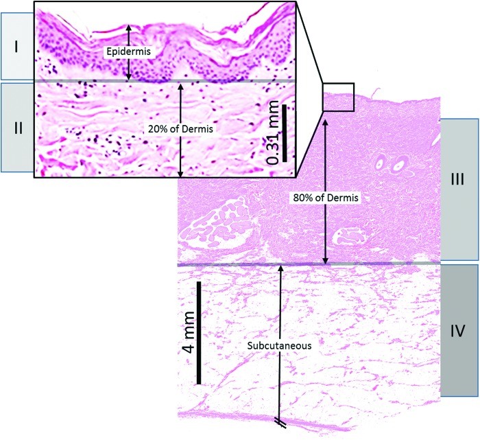 Skin depths of destroyed cells according to burn degree.