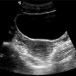 Transverse view of the urinary bladder.