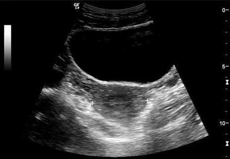 Transverse view of the urinary bladder.