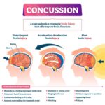 concussion infographic