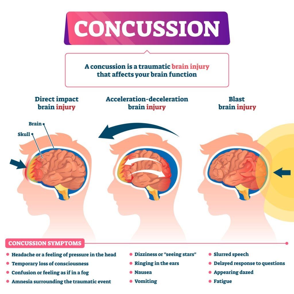 Infographic explaining concussion symptoms after a car accident head injury